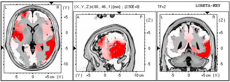LORETA analysis at 2 Hz showing lateralized excess activity